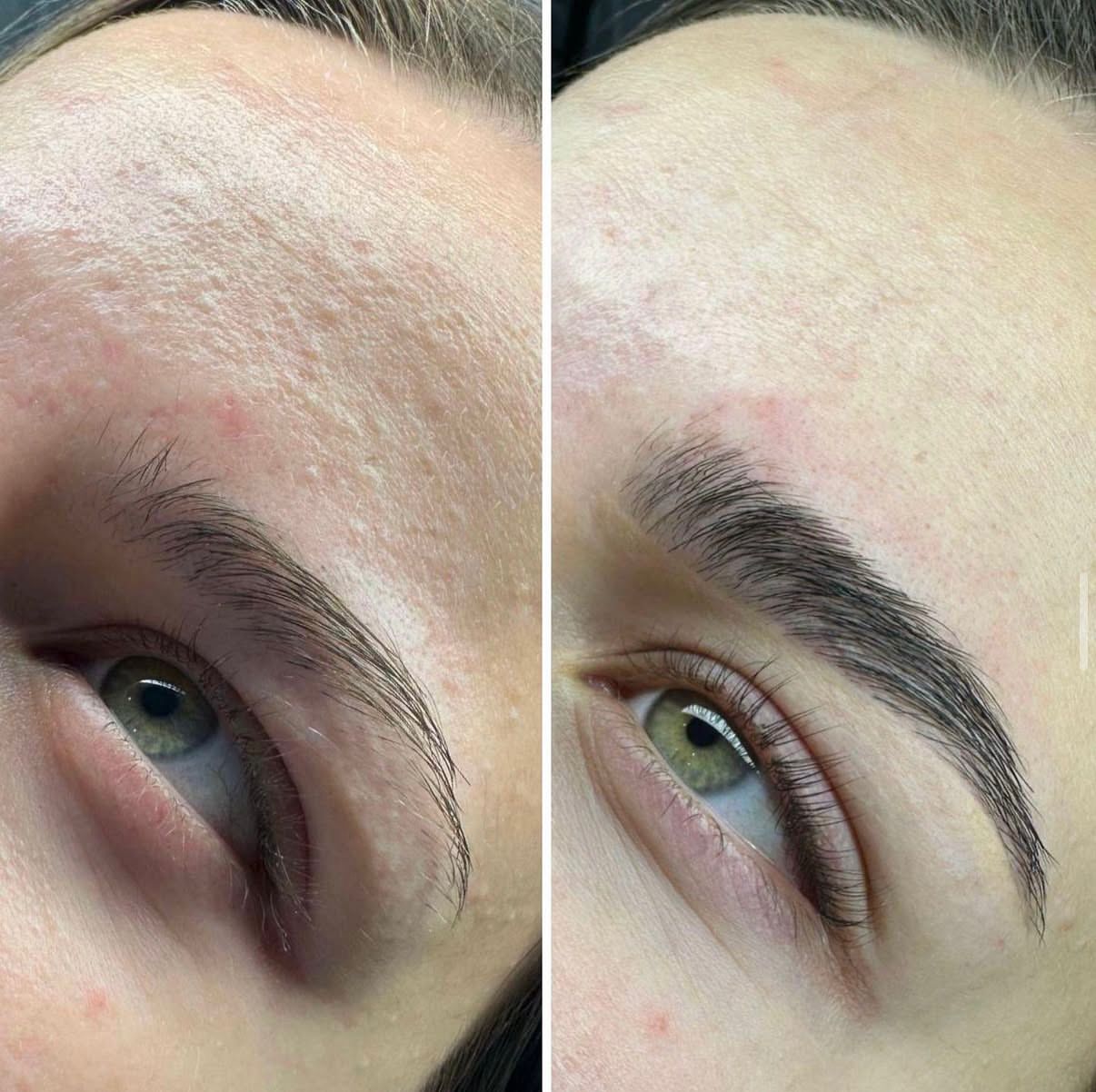 Browlift Ergebnis